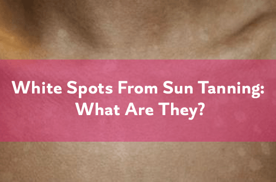 White spots from sun tanning: What are they?