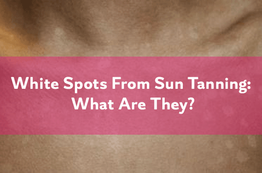 White spots from sun tanning: What are they?